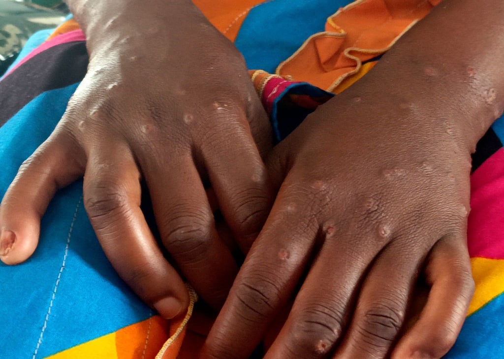 Mpox ist vor allem für kleine Kinder und immungeschwächte Menschen gefährlich (Archivbild)