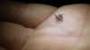 In Sachsen werden immer mehr Borreliose-Fälle registriert. (Archivbild)