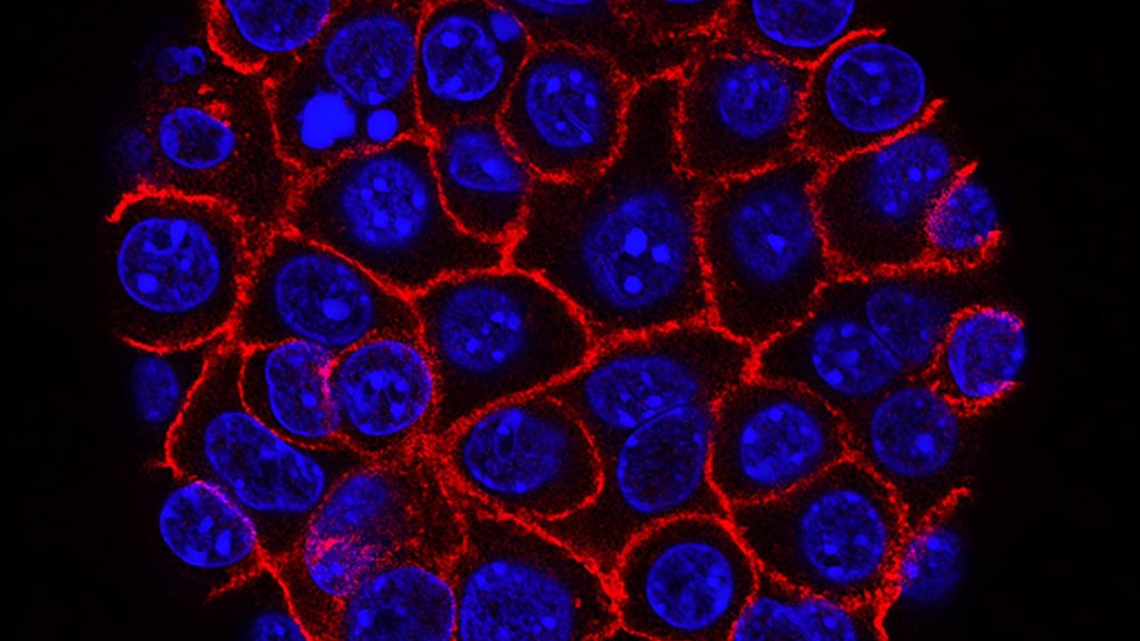 So sehen Zellen von Bauchspeicheldrüsenkrebs unter dem Mikroskop im Labor aus. 