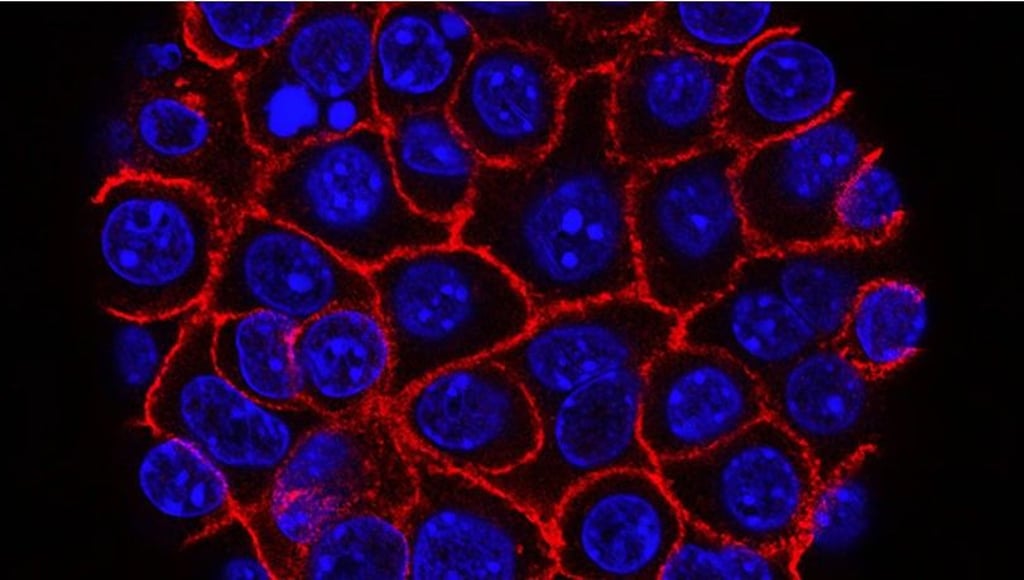 So sehen Zellen von Bauchspeicheldrüsenkrebs unter dem Mikroskop im Labor aus.