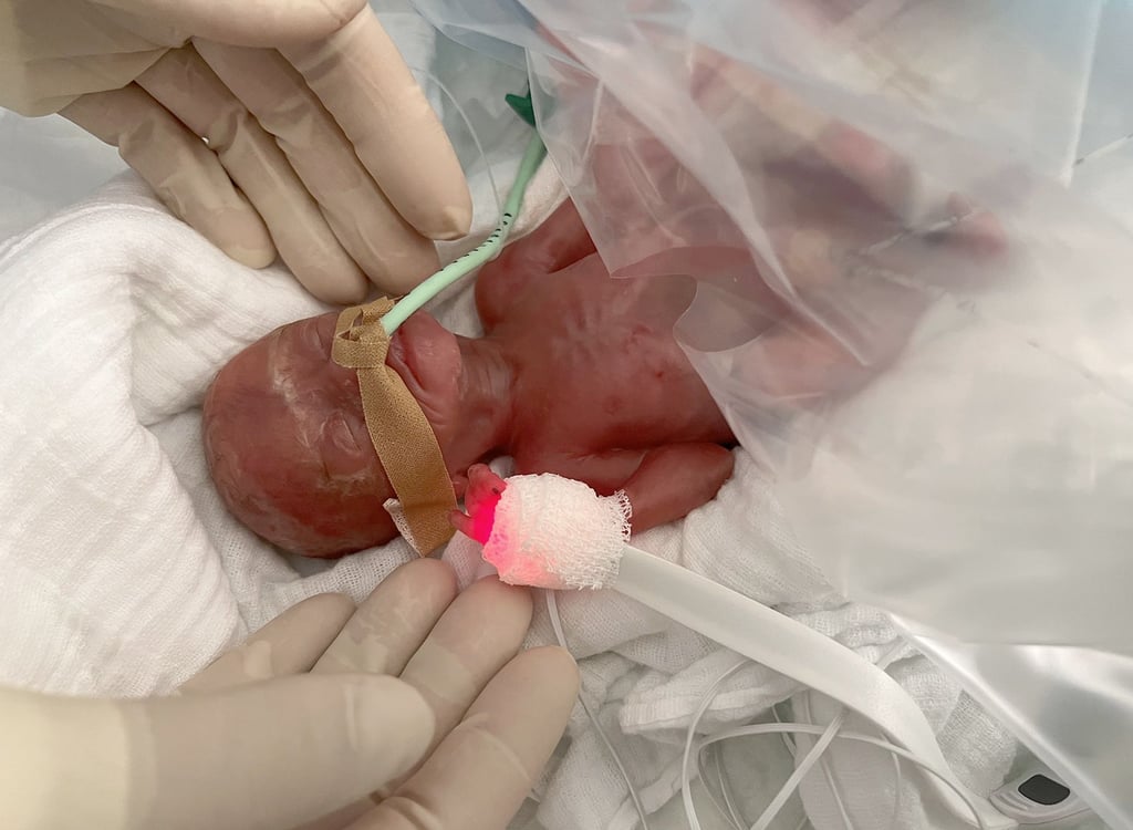 Das von den Medizinern der Uniklinik Magdeburg gerettete nur 300 Gramm schwere Frühchen kurz nach seiner Geburt im Perinatalzentrum.