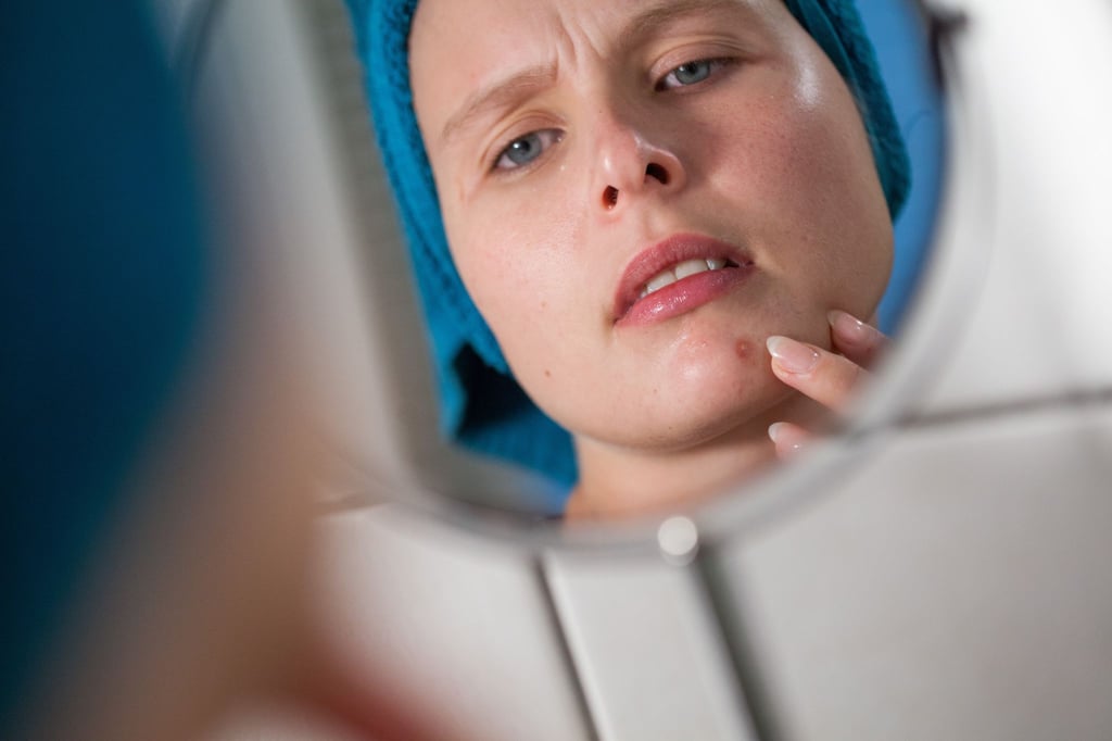 Mist, ein Pickel! Durch vermehrte Talgproduktion können Poren verstopfen und sich entzünden. Das stört viele nicht nur optisch, sondern tut manchmal auch richtig weh.